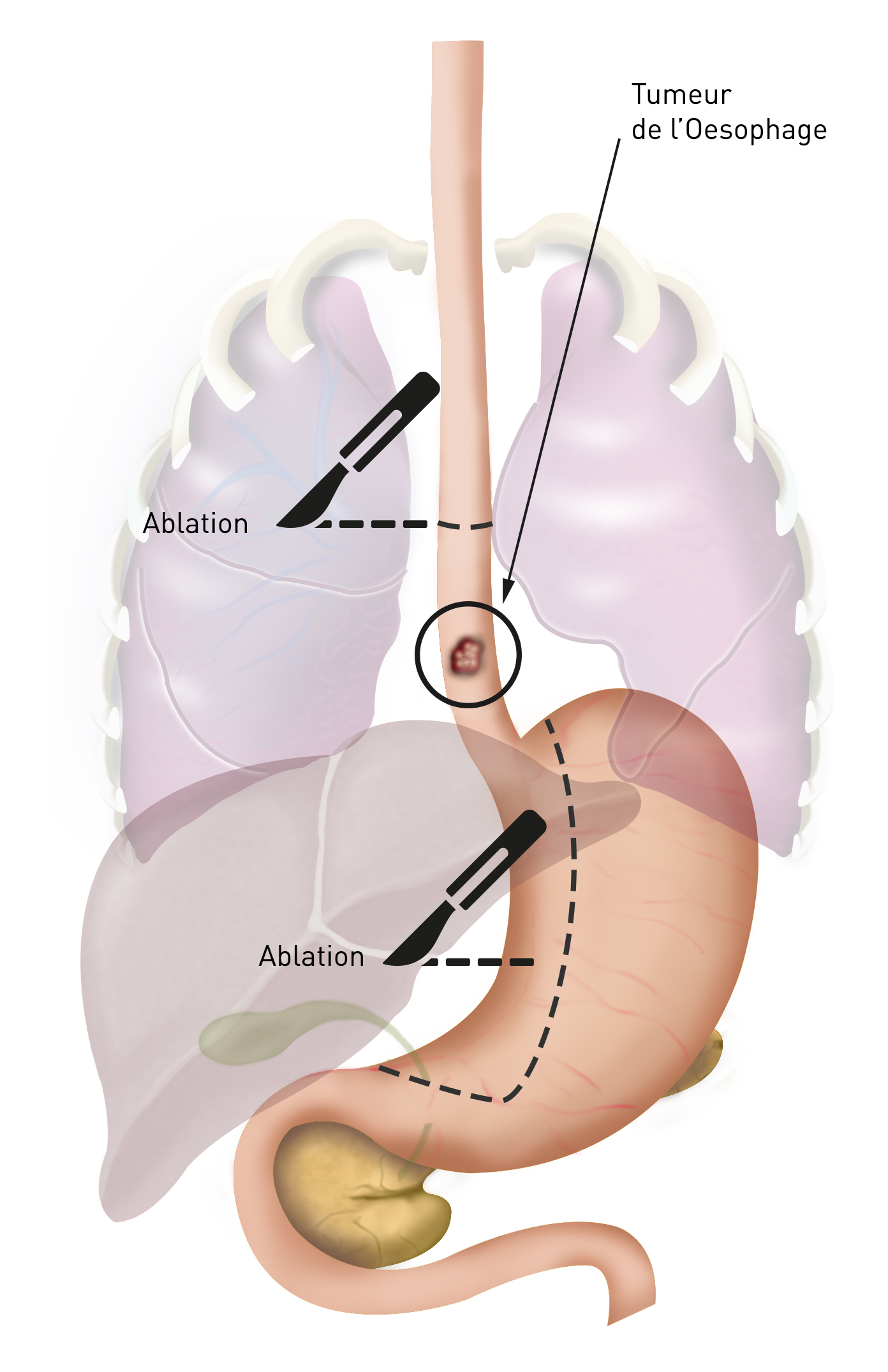 Gastrectomie partielle 1